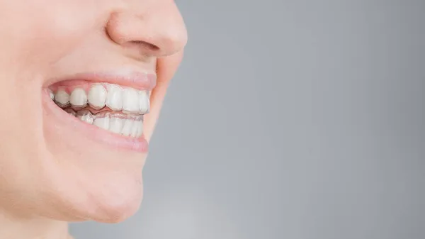 Gros plan portrait d'une femme portant un appareil de retenue en plastique transparent. Une fille corrige une morsure à l'aide d'un dispositif orthodontique — Photo