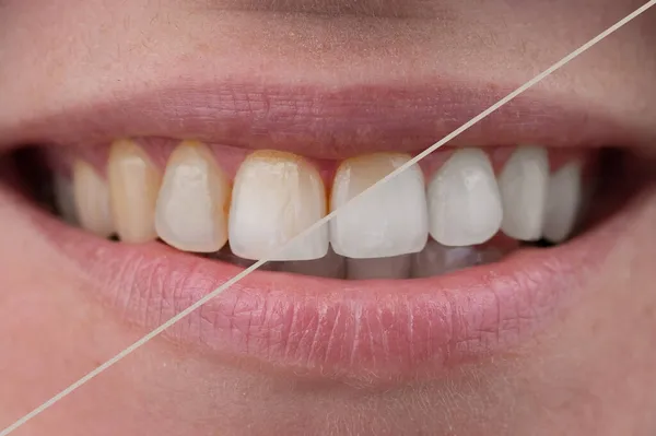 Zbliżenie kobiet uśmiech przed i po wybielaniu zębów. — Zdjęcie stockowe