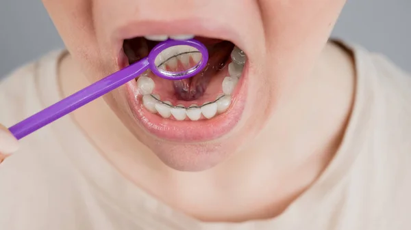 Detailní portrét ženy s vnitřními rovnátky a zubním zrcátkem. Dívka opravuje kousnutí. — Stock fotografie