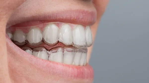 Primer plano de una mujer caucásica sonriendo con alineadores en los dientes. Macro. —  Fotos de Stock