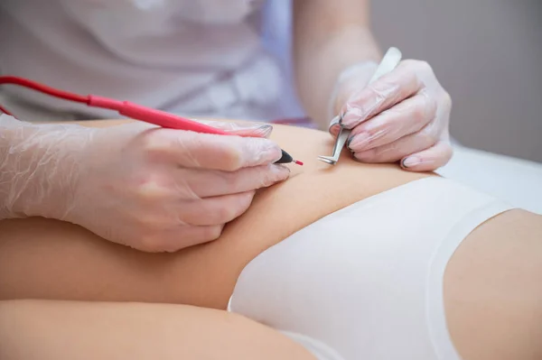 Doktor dělá elektro epilaci bikini zóny ženě v salonu. Alternativní způsob, jak trvale odstranit nežádoucí ochlupení těla — Stock fotografie