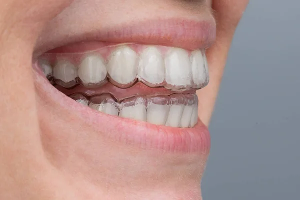 Close-up of a caucasian woman smiling with aligners on her teeth. Macro. — Stock Photo, Image