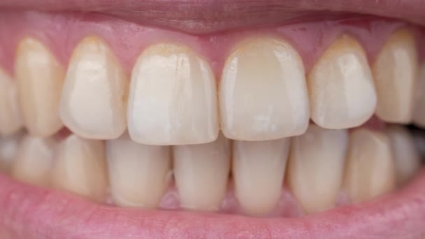 Close-up of a womans smile before and after teeth whitening. — Stock Video