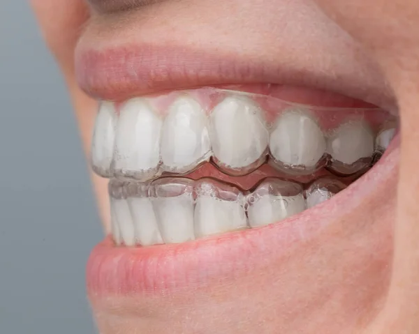 Primer plano de una mujer caucásica sonriendo con alineadores en los dientes. Macro. —  Fotos de Stock