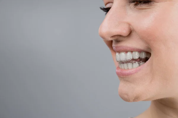 Detailní portrét ženy, jak si obléká průhledný plastový držák. Dívka koriguje kousnutí pomocí ortodontického zařízení — Stock fotografie