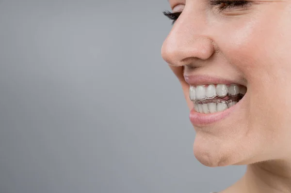 Großaufnahme Porträt einer Frau, die einen transparenten Kunststoffhalter anzieht. Ein Mädchen korrigiert einen Biss mit Hilfe eines kieferorthopädischen Geräts — Stockfoto