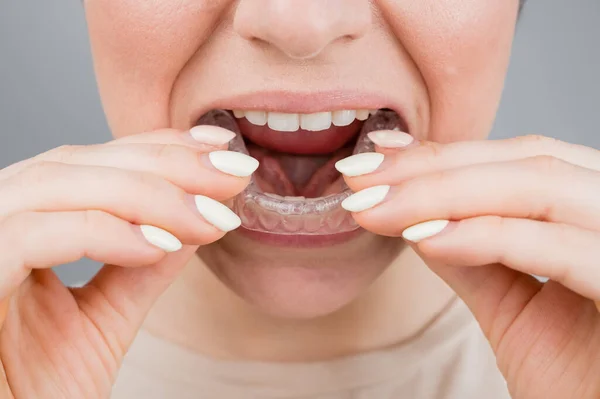투명 한 플라스틱 리시버를 입은 여성의 클로즈업 사진. 한 소녀가 치과 기구를 사용하여 물린 자리를 교정 한다 — 스톡 사진