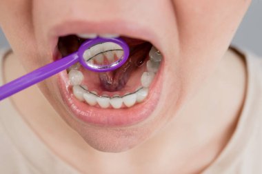 İç telleri ve diş aynası olan bir kadının yakın plan portresi. Kız ısırığı düzeltiyor.