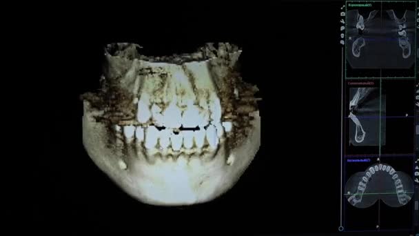 3D-modell av en röntgenbild av en mänsklig käke. Datorprogram för dentalavbildning — Stockvideo