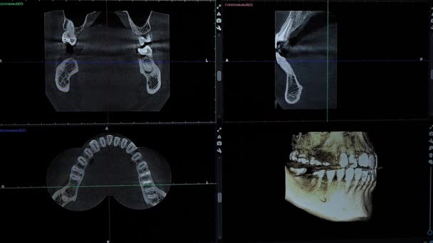 Modelo 3d de uma imagem de raio-x de uma mandíbula humana. Programa de computador para imagiologia dentária — Vídeo de Stock