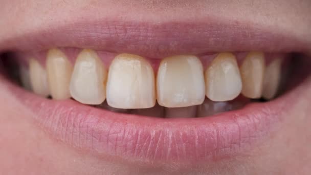 Close-up of a womans smile before and after teeth whitening. — Stock Video