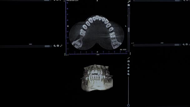 3d μοντέλο μιας εικόνας ακτίνων Χ ενός ανθρώπινου σαγονιού. Πρόγραμμα ηλεκτρονικών υπολογιστών για οδοντιατρική απεικόνιση — Αρχείο Βίντεο