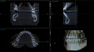 Bir doktor, insan çenesinin 3 boyutlu x-ray modeli üzerinde diş sorunları gösterir