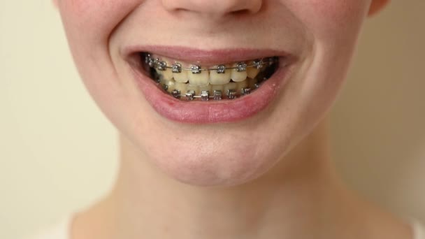 Close-up ของหญิงสาวที่ยิ้มและชี้นิ้วไปที่ฟันของเธอด้วย braces . — วีดีโอสต็อก