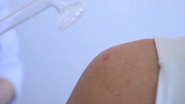 Doktor, kadın bir hastanın omzundaki sivilcelere karşı darsonval aparatı kullanıyor..