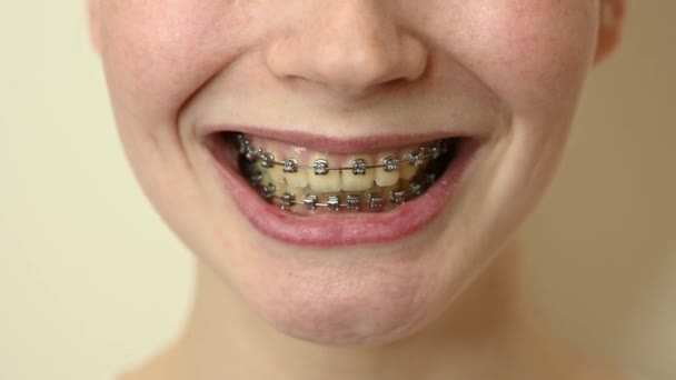 Detailní záběr mladé ženy usmívající se s rovnátky na zubech. — Stock video