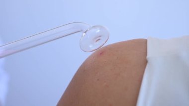 Doktor, kadın bir hastanın omzundaki sivilcelere karşı darsonval aparatı kullanıyor..