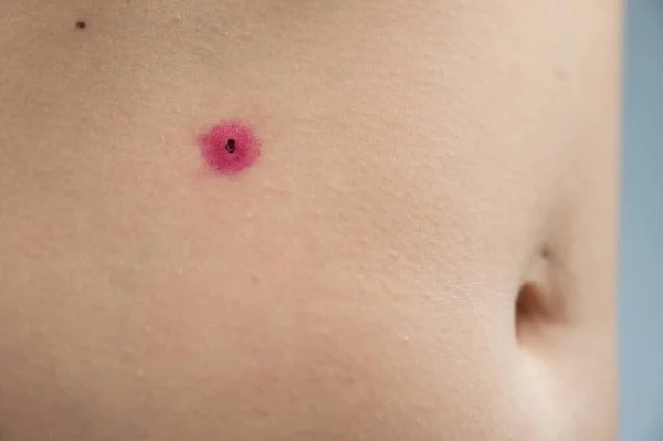 女性腹部被切除的疣子的特写 燃烧后的人类乳头瘤病毒 — 图库照片
