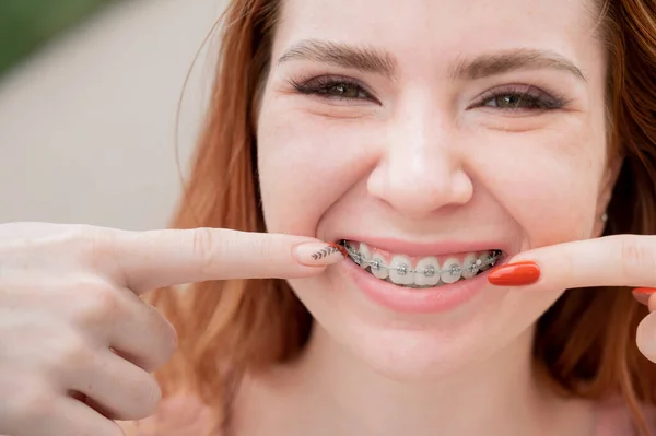 Young Red Haired Woman Braces Her Teeth Point Smile Outdoors — Stock Photo, Image