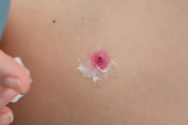 一个女人在烧伤了一个疣子之后 在伤口上涂上了润肤霜 — 图库照片