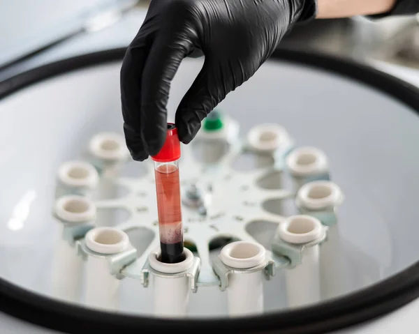 Arts Haalt Een Reageerbuis Met Bloedplasma Uit Centrifuge Plasmahijsprocedure Voor — Stockfoto