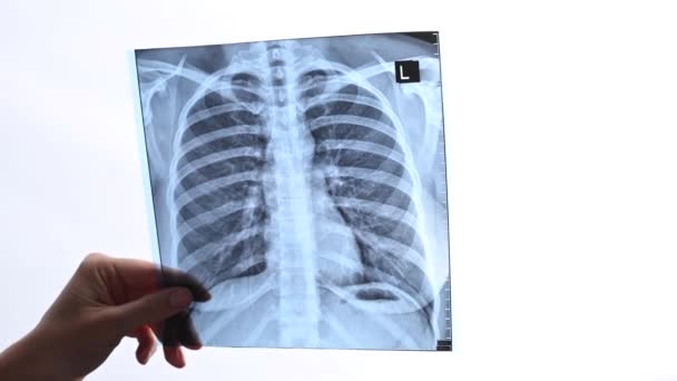 Doktor Hastaların Akciğerlerinin Röntgenini Gösteriyor — Stok video