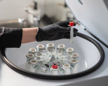 Doktor santrifüjden kan plazması olan bir test tüpü çıkardı. Cilt gençleştirme için plazma kaldırma işlemi