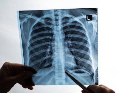 Doktor hastaların akciğerlerinin röntgenini gösteriyor.