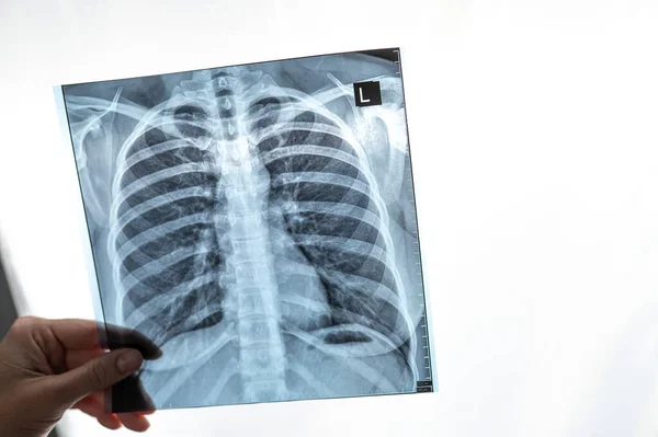 Médico Mostrando Raio Dos Pulmões Dos Pacientes — Fotografia de Stock