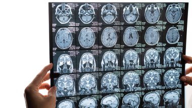 Kadın bir doktor beyin MR taramasını inceliyor.