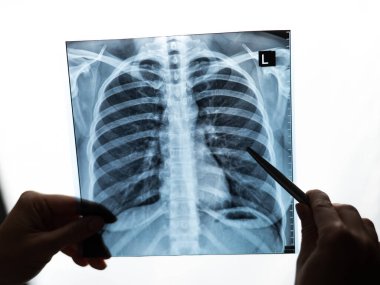 Doktor hastaların akciğerlerinin röntgenini gösteriyor.