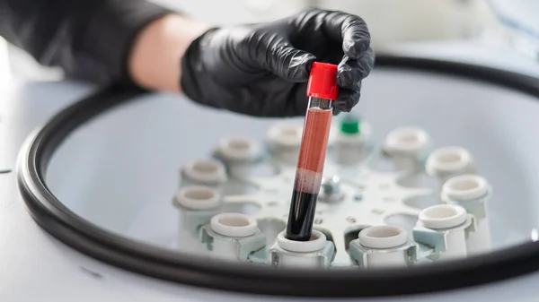 Arts Haalt Een Reageerbuis Met Bloedplasma Uit Centrifuge Plasmahijsprocedure Voor — Stockfoto