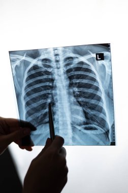 Doktor hastaların akciğerlerinin röntgenini gösteriyor.