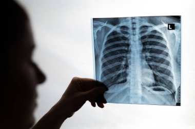 Doktor hastaların akciğerlerinin röntgenini gösteriyor.