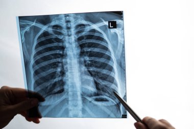 Doktor hastaların akciğerlerinin röntgenini gösteriyor.