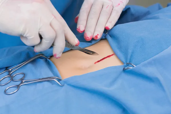 Cirurgião incisando um estômago paciente — Fotografia de Stock