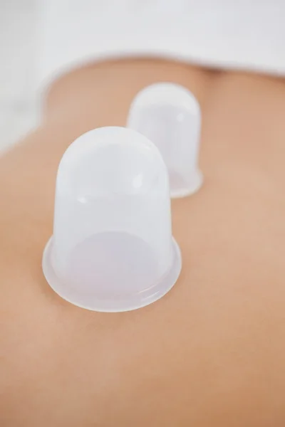 Woman with vacuum cups on her back — Stock Photo, Image