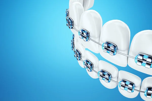 Белые Зубы Металлическими Брекетами Синем Фоне Стоматологические Брекеты Ортодонтическое Лечение — стоковое фото