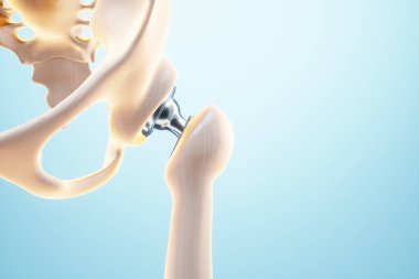 Kalça implantının tıbbi poster resmi. yapay eklem, artrit, iltihap, kırık, kıkırdak. 3B illüstrasyon, 3B canlandırma