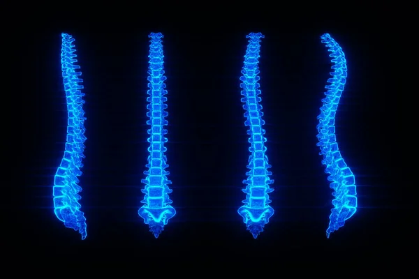 Medical Poster Anatomy Human Spine Image Bones Hologram Arthritis Inflammation — Stock Photo, Image