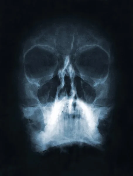 Skallen röntgenbilden — Stockfoto