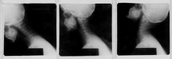 Cervical spine — Stock Photo, Image