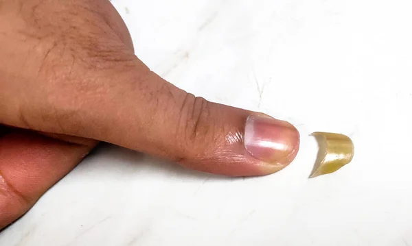 Людський Великий Палець Відрізаний Цвях Білому Тлі — стокове фото