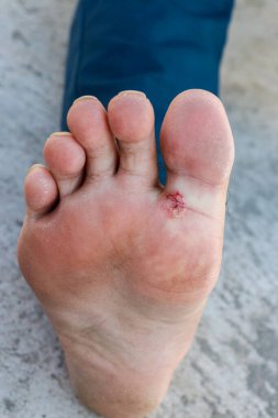 Atletin ayağı - tinea pedis, mantar enfeksiyonu ya da dermatitli ayak tabanı, konu yumuşak odaklanmadır