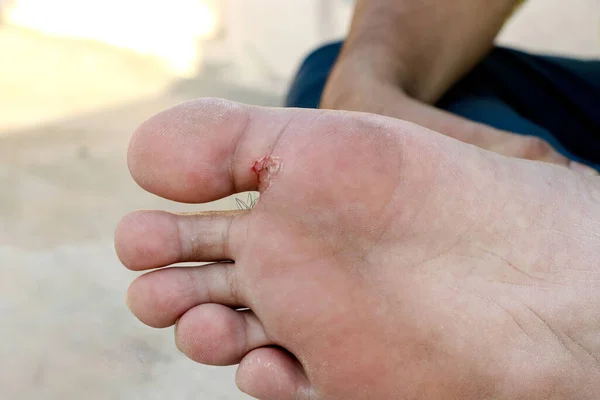 Atleetvoet Tinea Pedis Schimmelinfectie Zool Van Voeten Met Dermatitis Onderwerp — Stockfoto