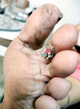 A close up of Indian woman foot with cracks