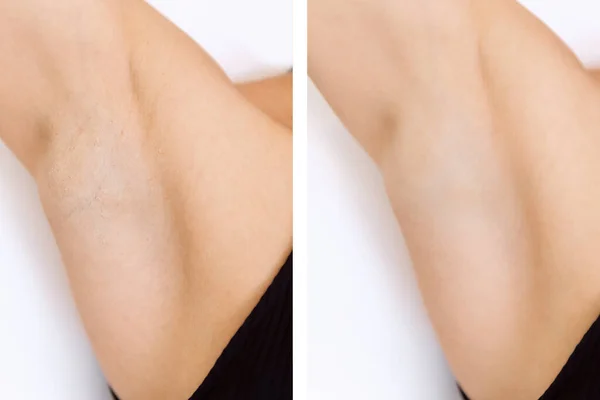 Women underarm hair removal. Concept before and after shaving laser — Stock Photo, Image