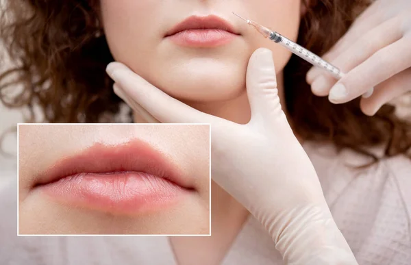 Przed i po wstrzyknięciu leku do ust dla młodej kobiety. Procedura powiększania z tworzywa sztucznego piękna — Zdjęcie stockowe