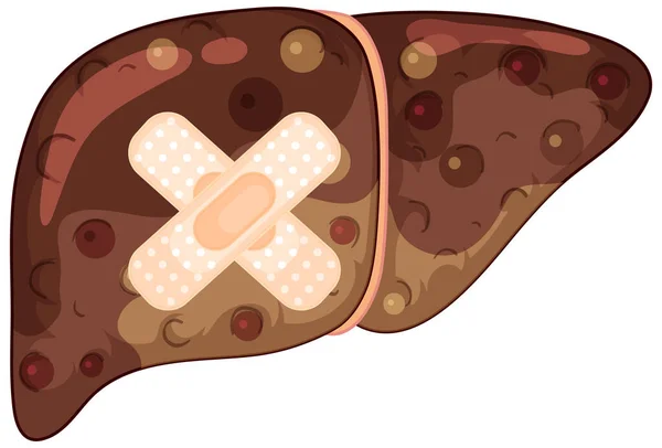 Hígado Fibrosis Con Yeso Cruzado Sobre Fondo Blanco Ilustración — Archivo Imágenes Vectoriales