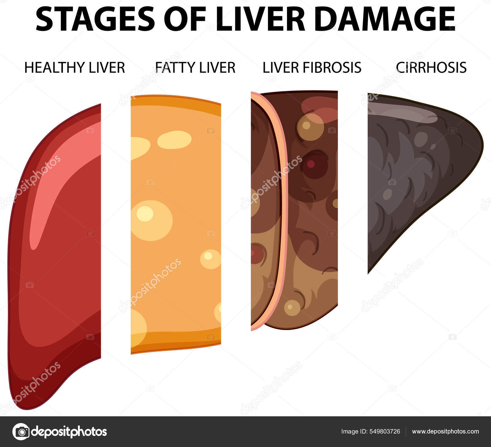Diagramme Montrant Les Stades Des Lésions Hépatiques Illustration
